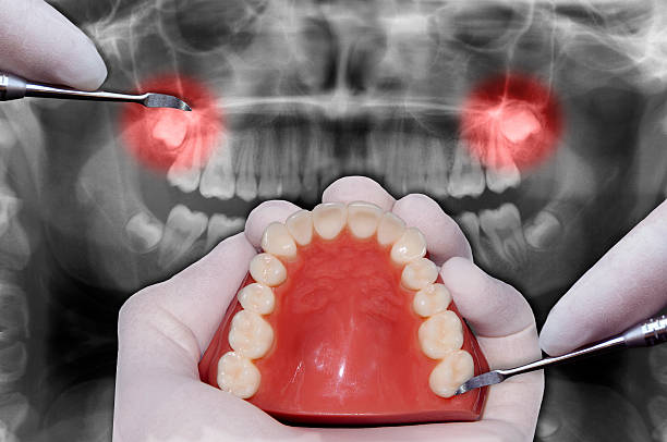 Why Your Wisdom Teeth May Need to Be Removed? | LogCla.com