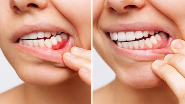 Tips to Recover Easily from Periodontal Treatment