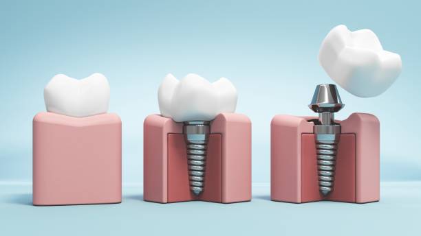 Dental Implants: Surgery, Purpose & Benefits