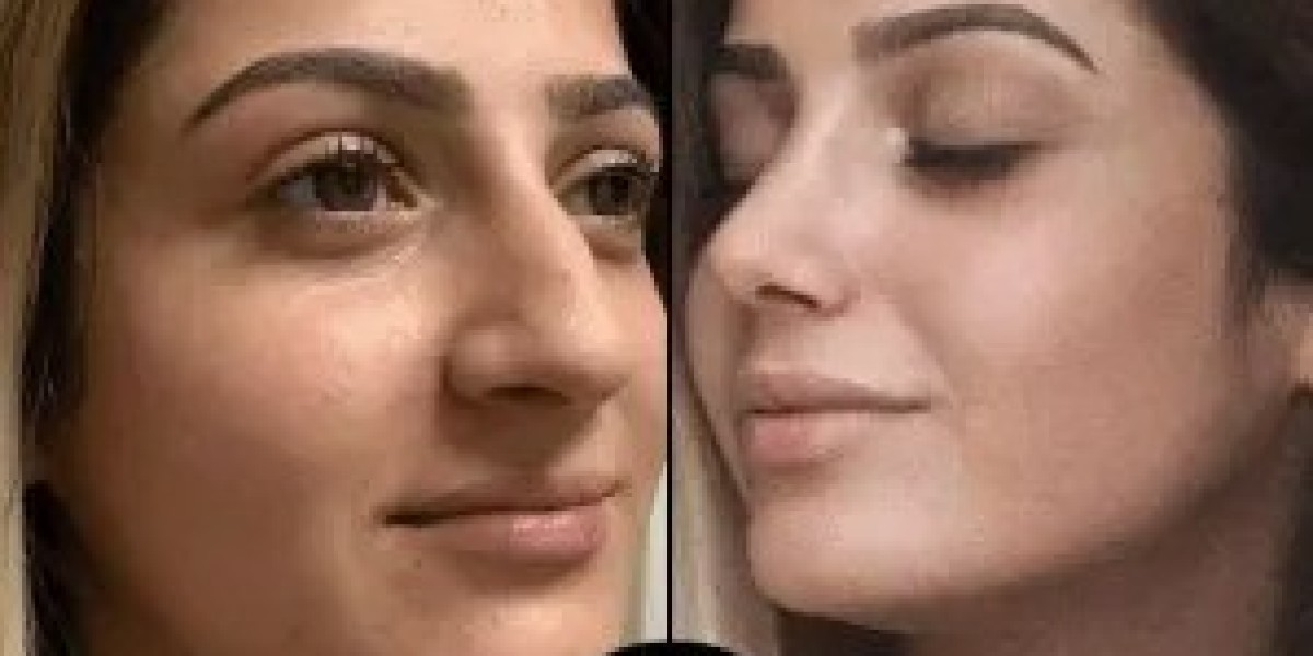 The Truth About PRP Treatments in Dubai – My Personal Experiences
