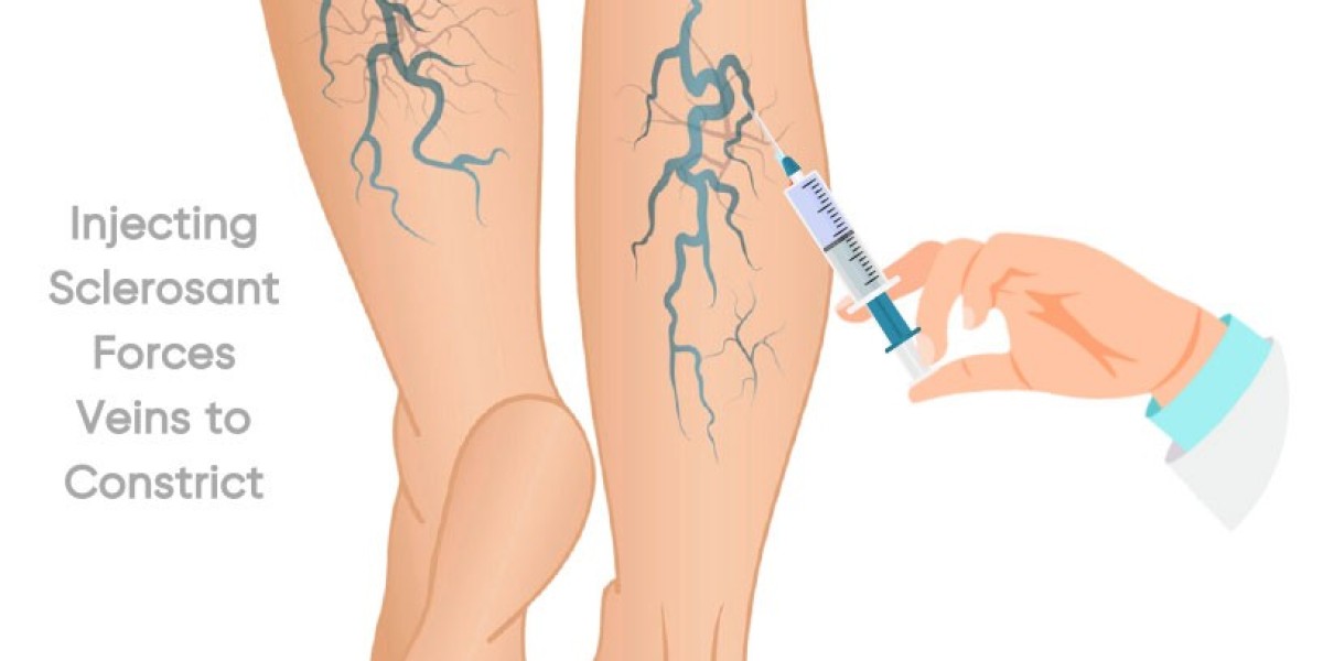 Varicose Veins Doctor Near Me – Local Experts in Vein Care