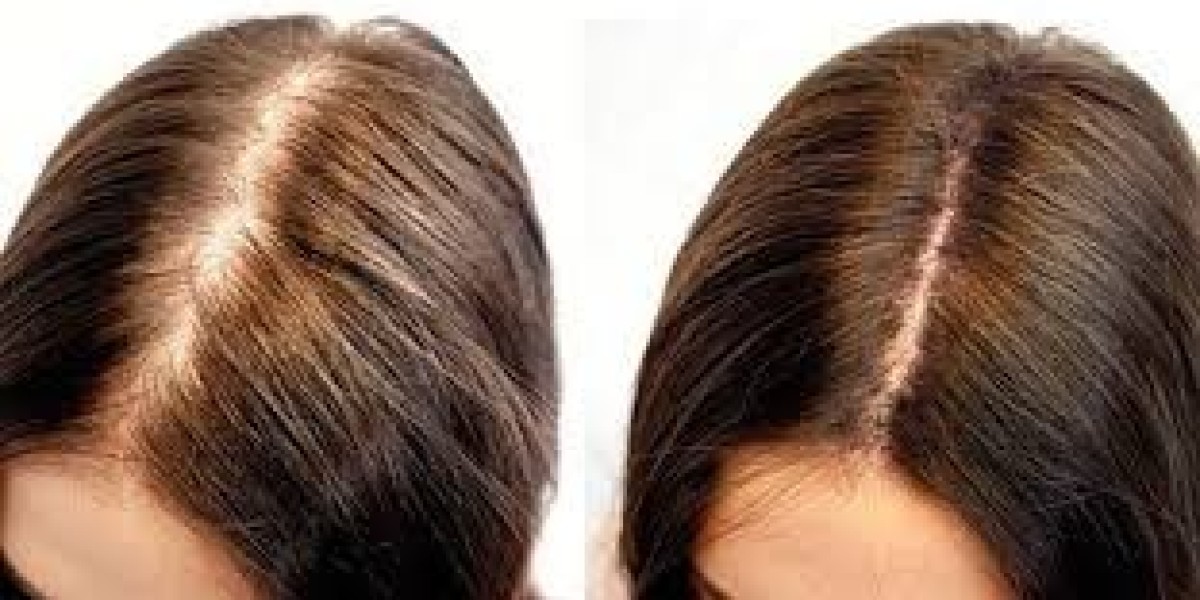 Thinning Hair? Could Hair Fillers Be Your Secret Weapon in Dubai?