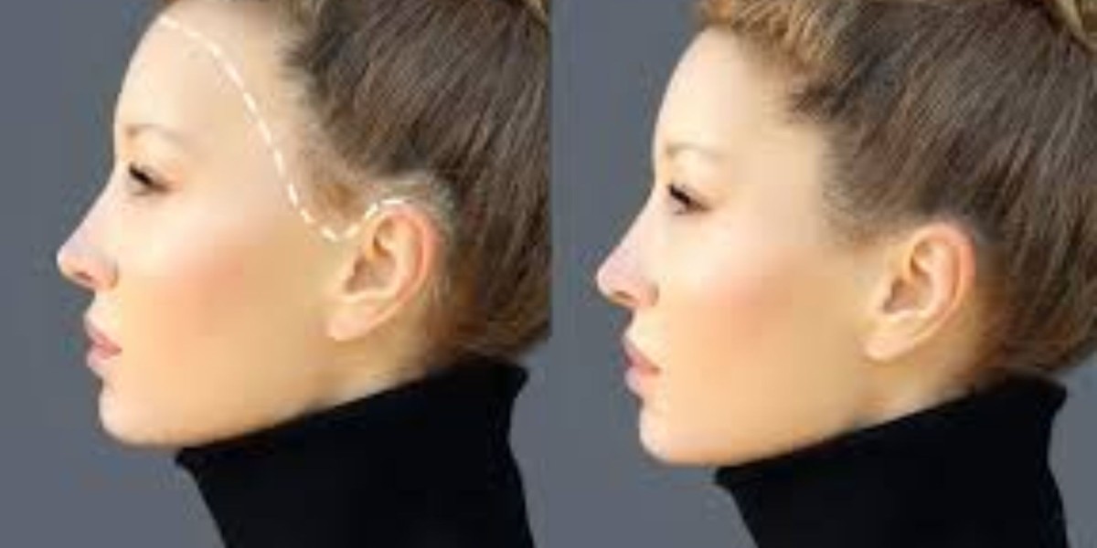 A Complete Guide to Forehead Lift Surgery and Recovery