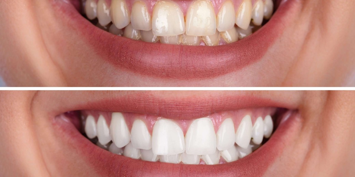 How Often Can You Safely Get Your Teeth Whitened?