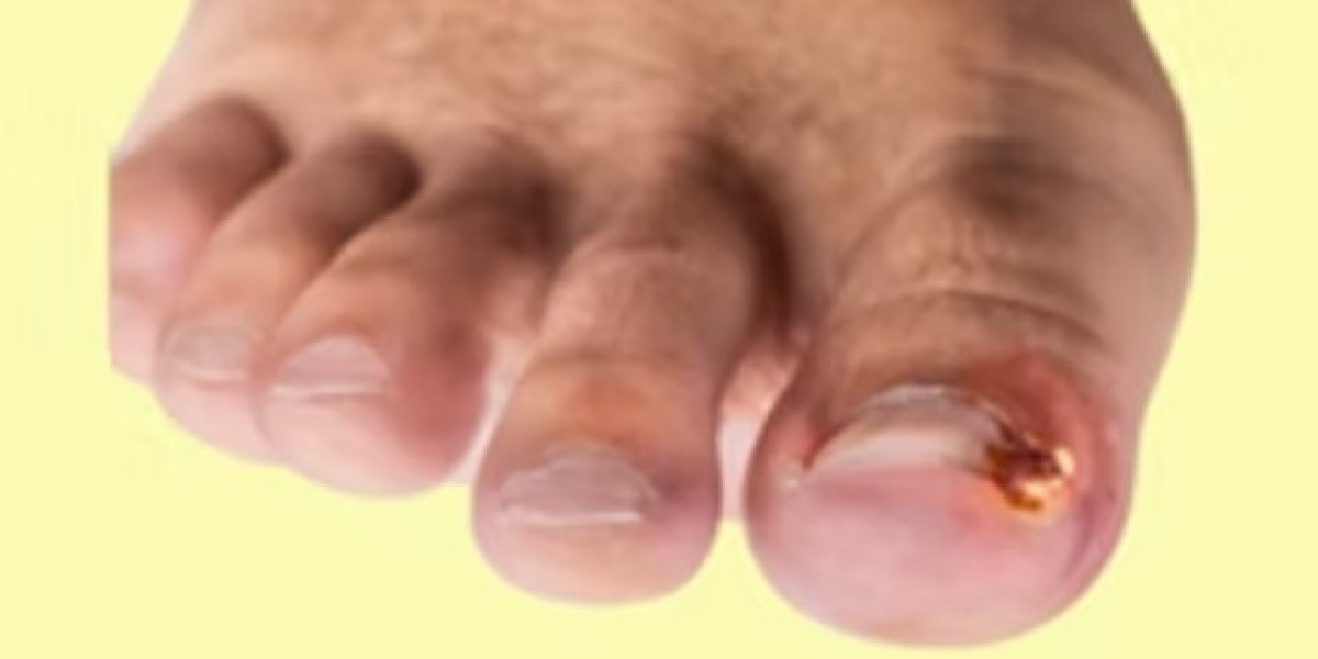 Why See a Podiatrist and Ingrown Toenail Specialist for Recurring Nail Pain