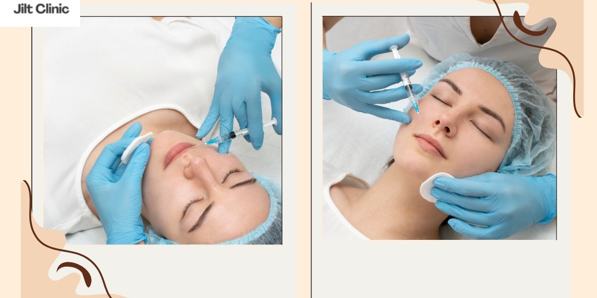 Marionettenfalten – Ursachen, Behandlungsmöglichkeiten