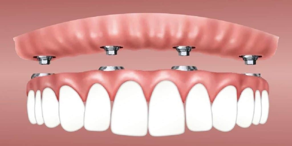 Full Mouth Dental Implants with Us