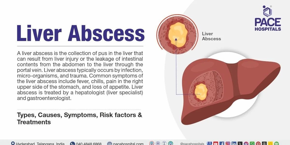 What Causes Liver Abscesses and How to Spot Them Early?
